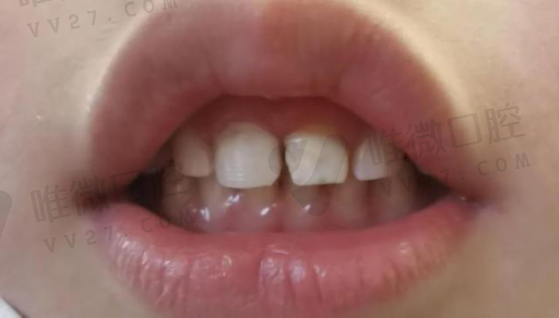 假牙清洁片和牙套的区别,烤瓷牙套里的牙会烂吗(图1)
